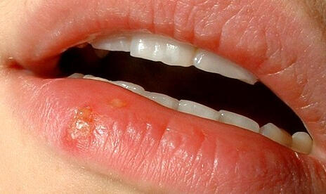 Herpes Causes THIS Killer Disease (You Won't Believe This).