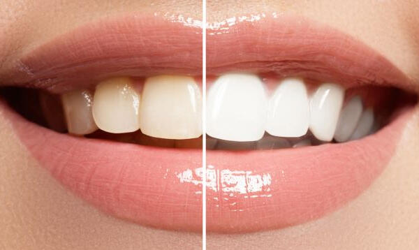 How to Effortlessly Erase Yellow Teeth from Smoking!